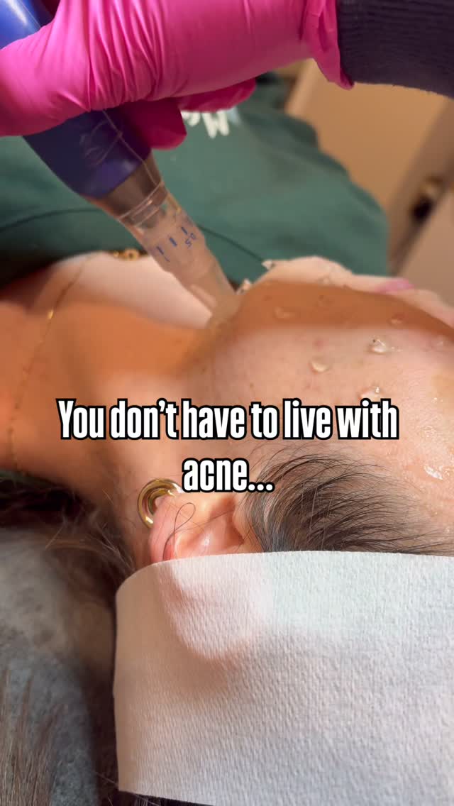 Microneedling