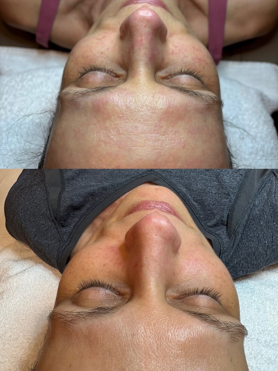 Dermaplaning